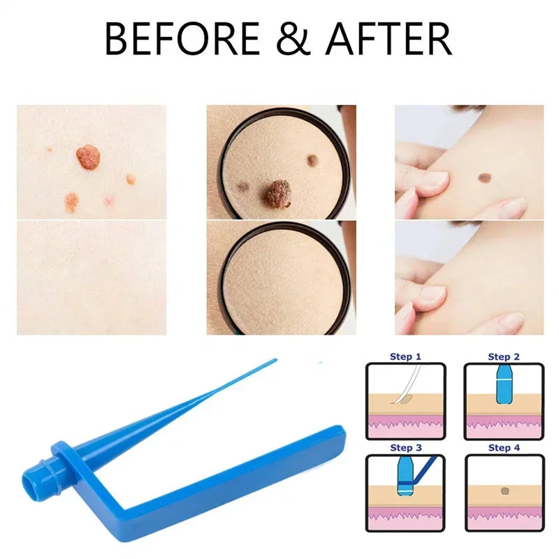 Skin Tag Removal Kit Skin Mole Wart Remover Micro Band Skin Tag Removal Kit Tag Treatment Tools Set with Cleansing Swabs Facial