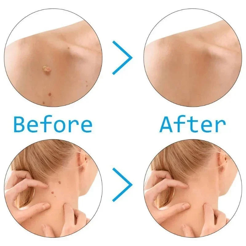 Skin Tag Removal Kit Skin Mole Wart Remover Micro Band Skin Tag Removal Kit Tag Treatment Tools Set with Cleansing Swabs Facial