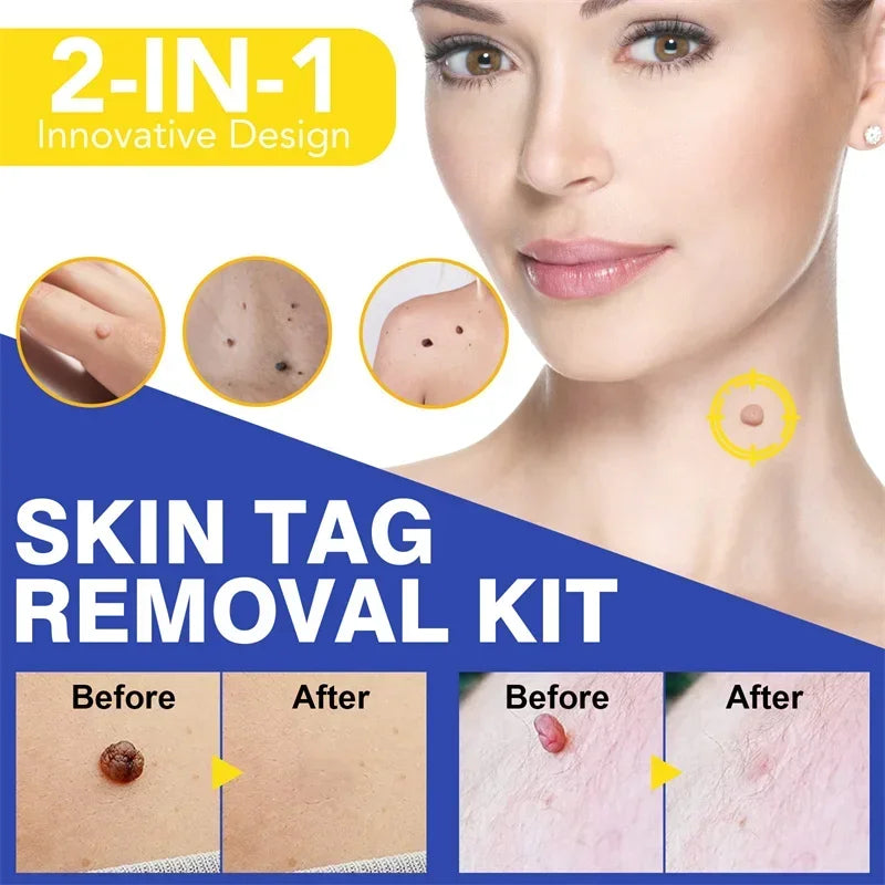 Skin Tag Removal Kit Skin Mole Wart Remover Micro Band Skin Tag Removal Kit Tag Treatment Tools Set with Cleansing Swabs Facial