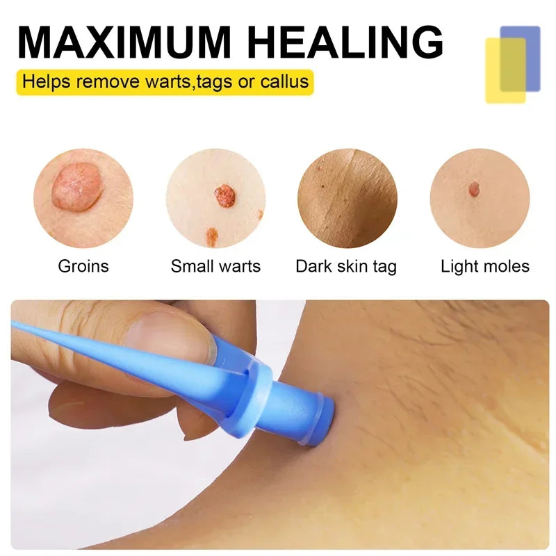 Skin Tag Removal Kit Skin Mole Wart Remover Micro Band Skin Tag Removal Kit Tag Treatment Tools Set with Cleansing Swabs Facial