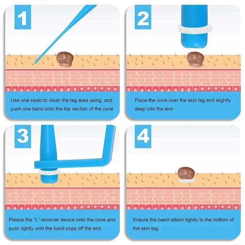 Skin Tag Removal Kit Skin Mole Wart Remover Micro Band Skin Tag Removal Kit Tag Treatment Tools Set with Cleansing Swabs Facial